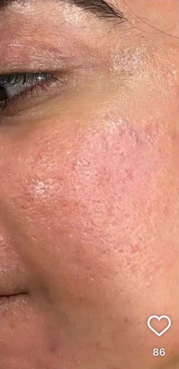 Acne after