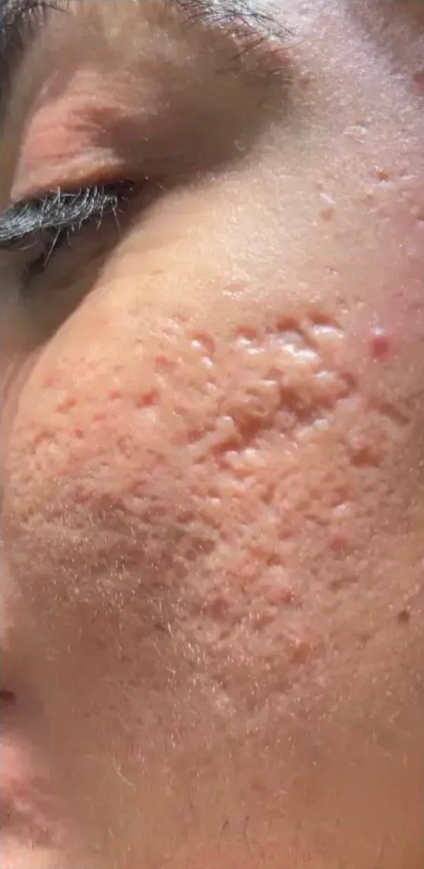 Acne before