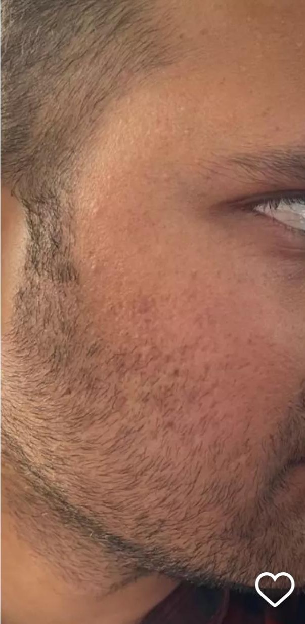 Acne Scar after