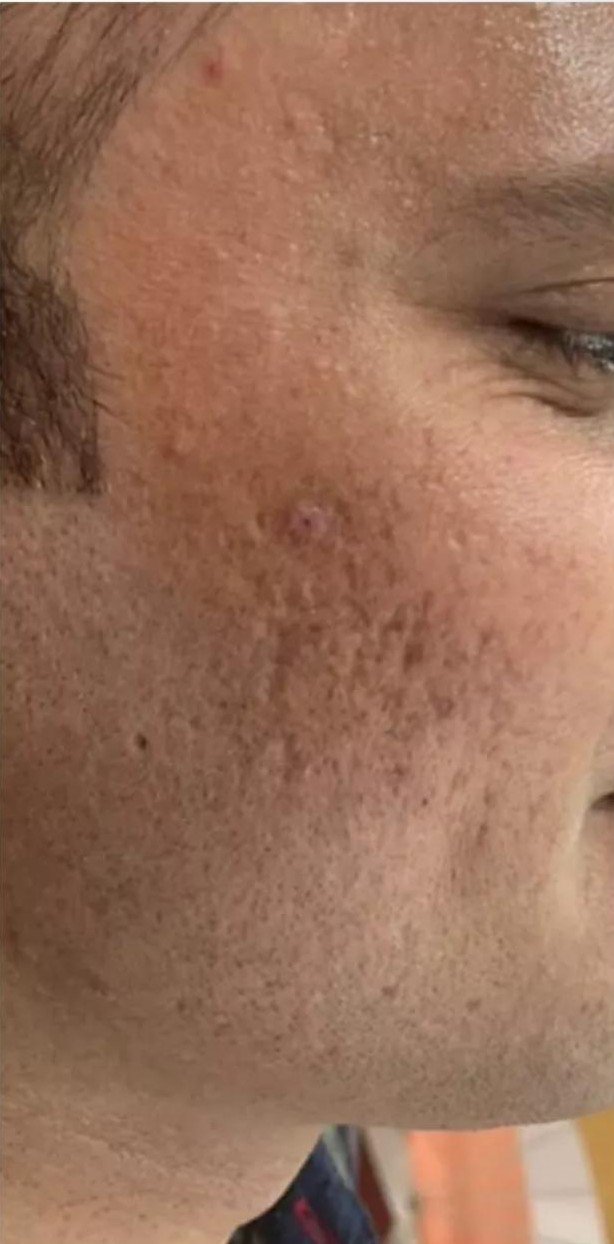 Acne Scar before