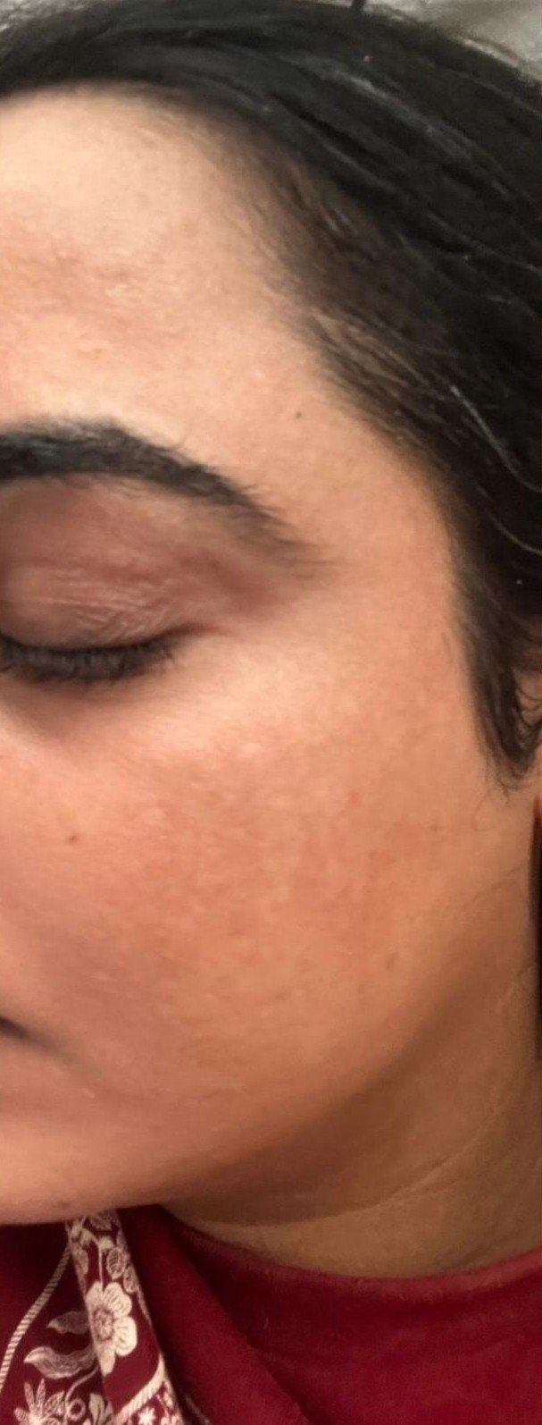 Melasma after