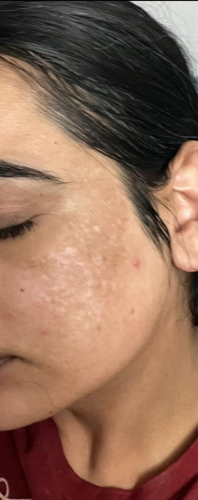 Melasma before