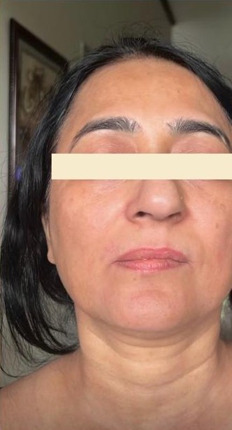 Pigmentation after
