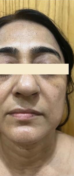 Pigmentation before
